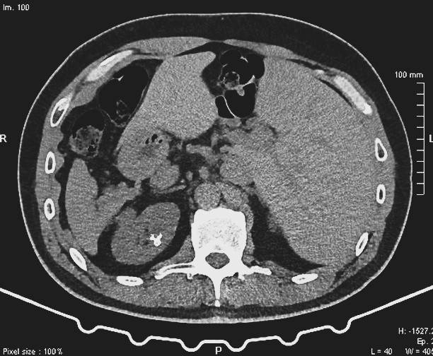 Calcolosi urinaria: formazione dei calcoli