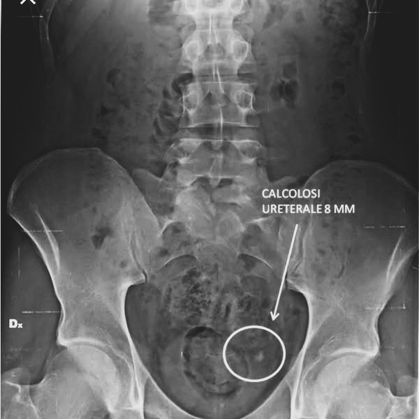 Urolitiasi e calcoli delle vie urinarie