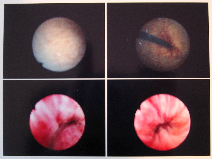 Immagine endoscopica della vescica