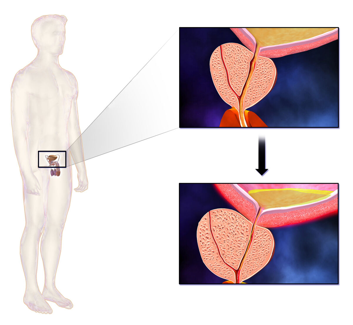 Prostata ingrossata che restringe l'uretra