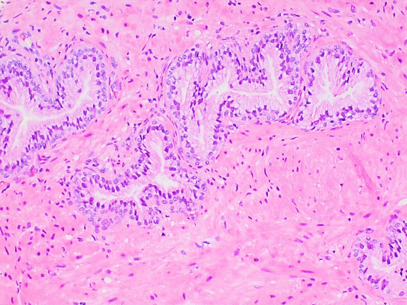 Tessuto prostatico al microscopio