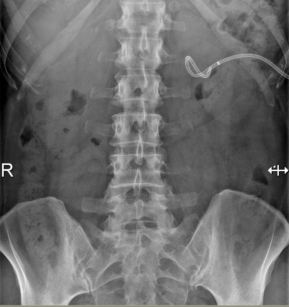 Radiografia di una nefrostomia