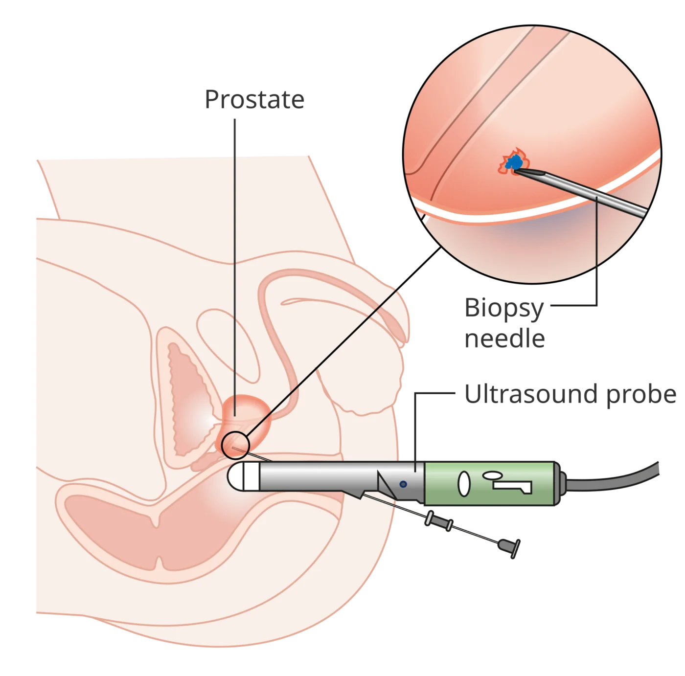 Schema della biopsia prostatica