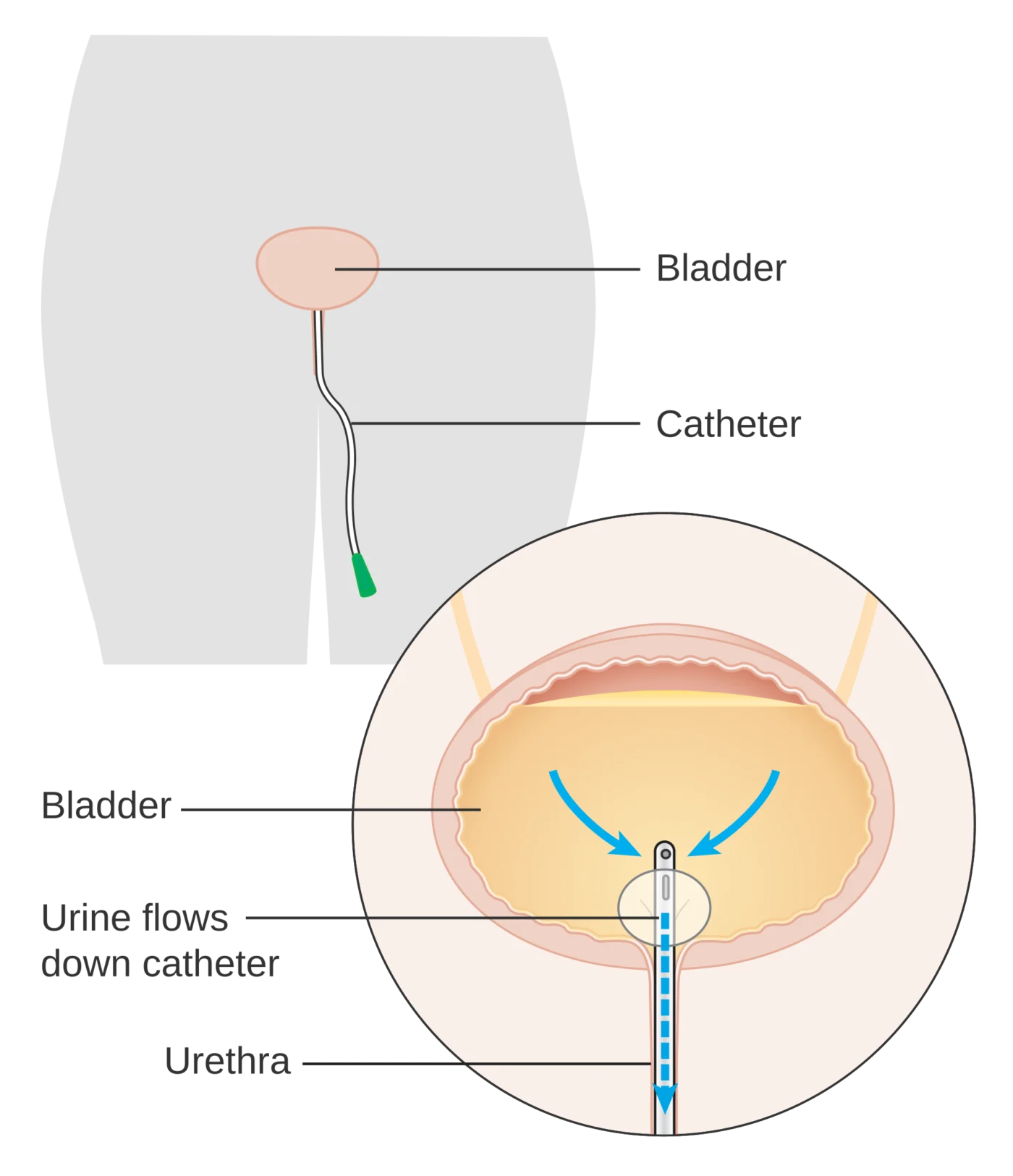 Schema del cateterismo vescicale