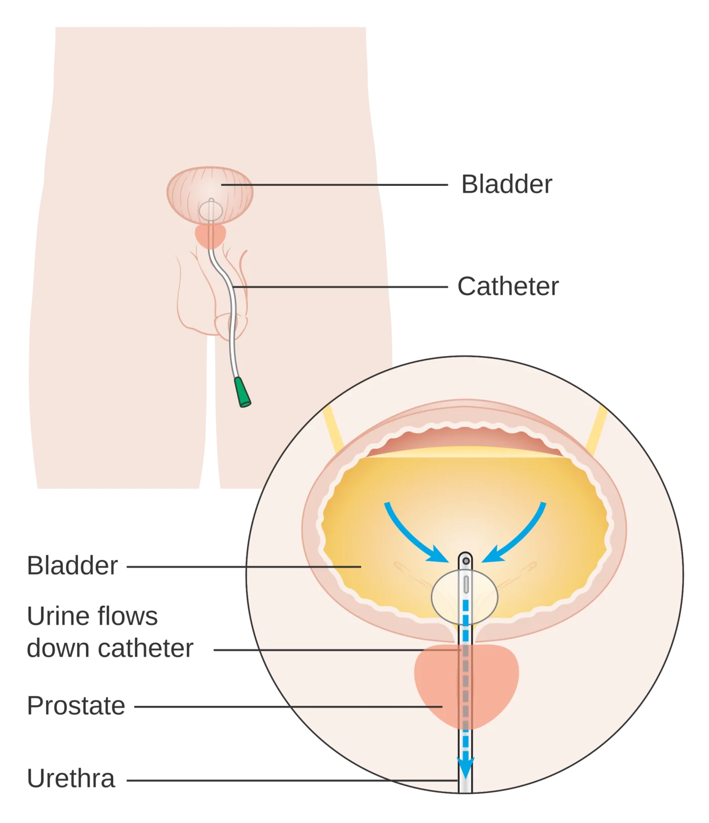 Schema del cateterismo vescicale