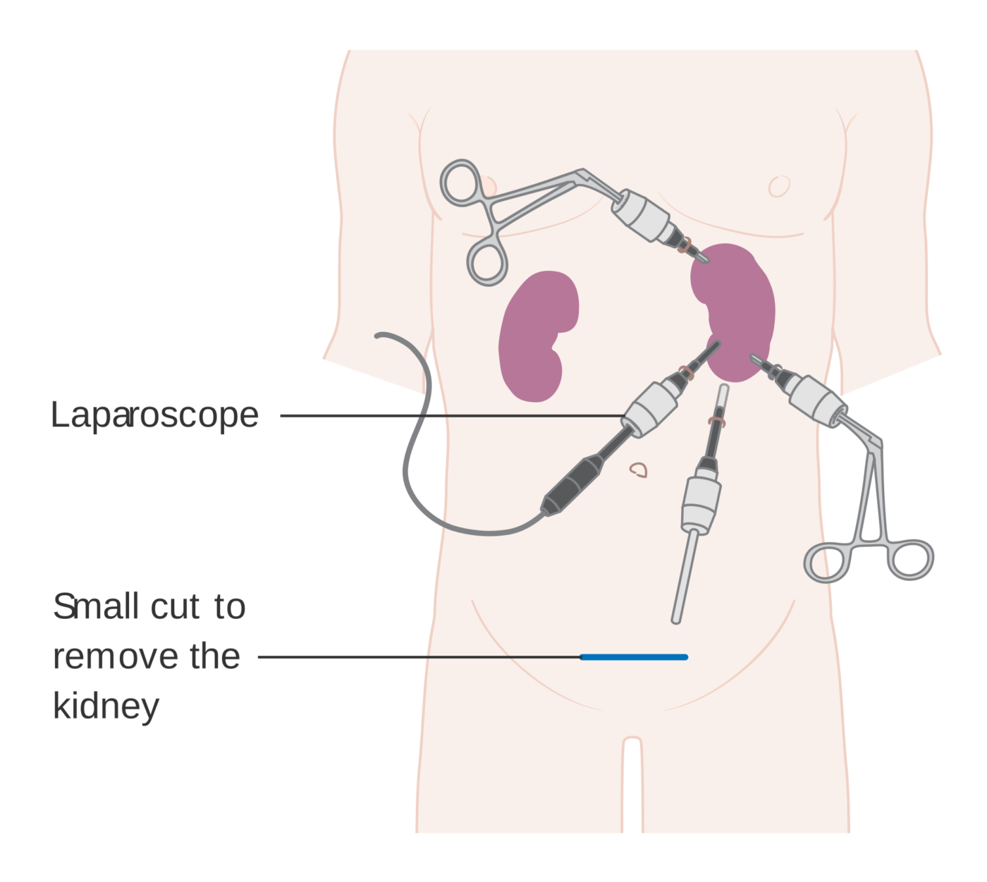 Chirurgia laparoscopica del rene