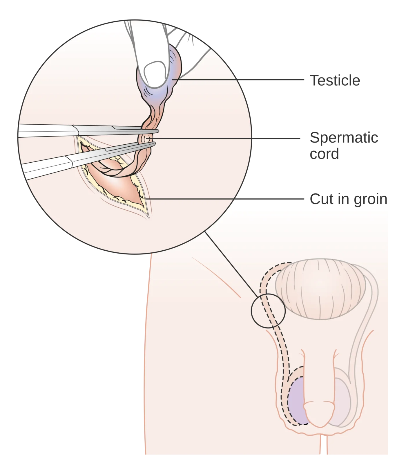 Schema dell'orchifunicolectomia