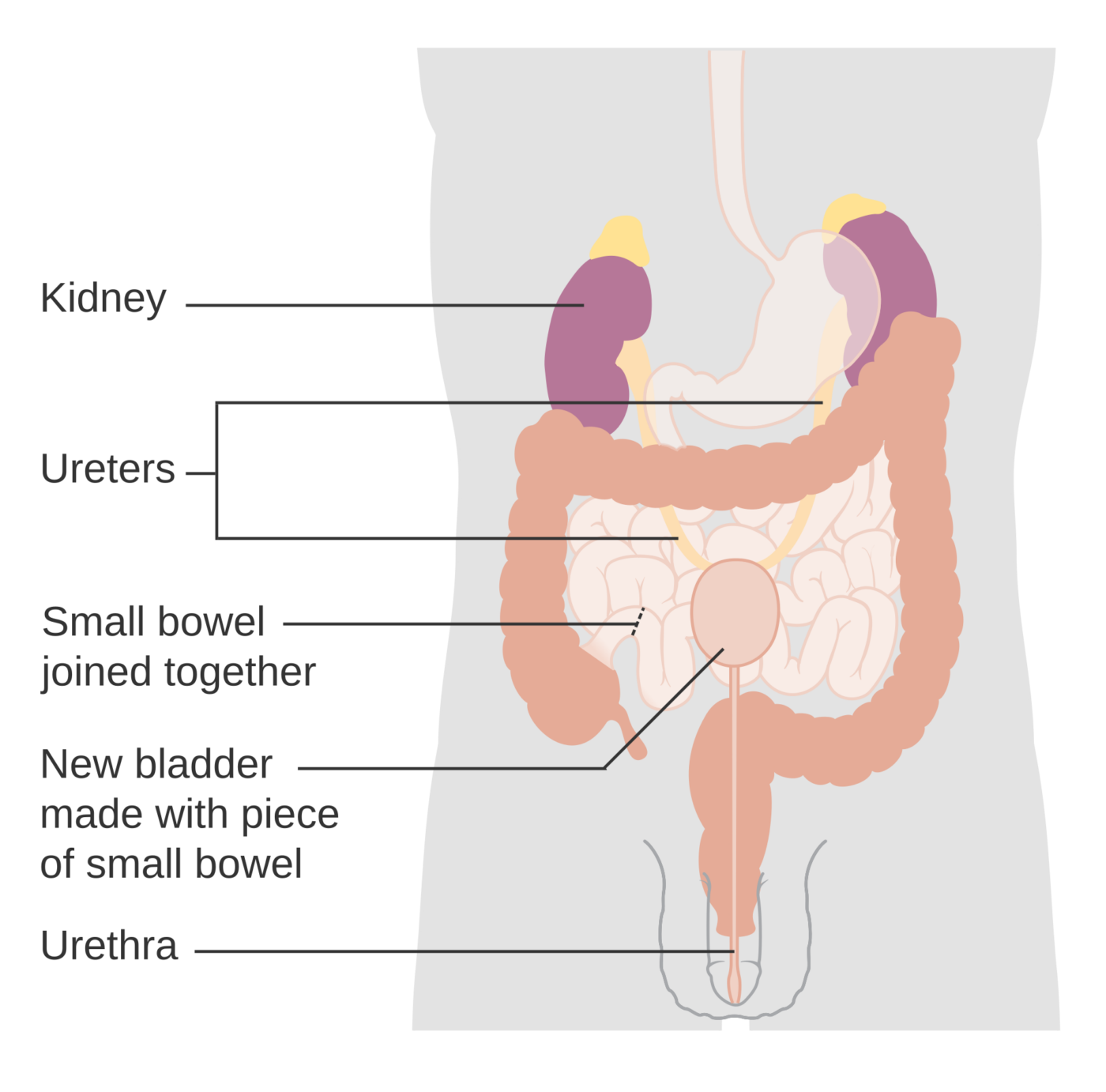 Ricostruzione della vescica con ansa intestinale