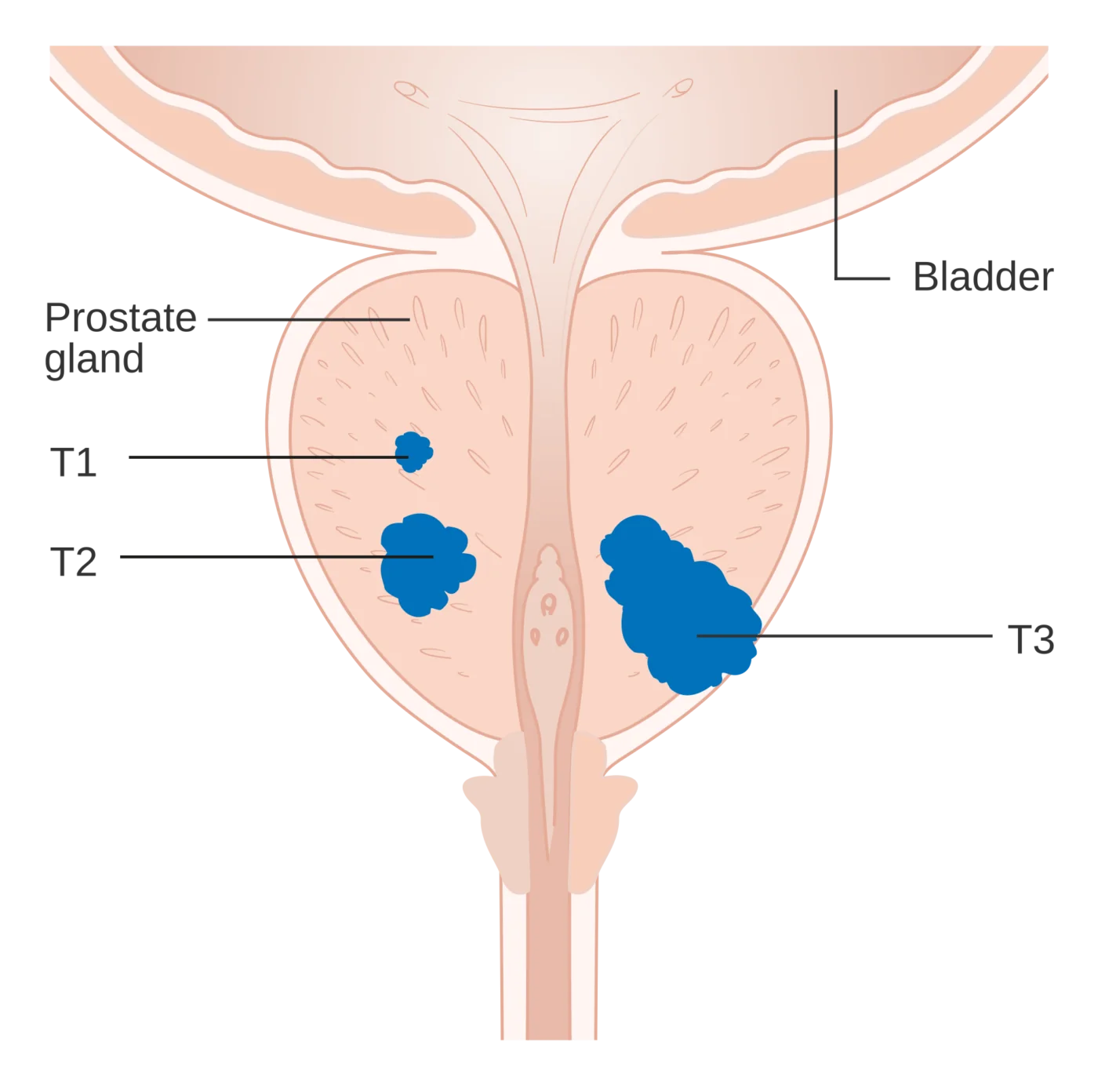 Stadi T1-T3 del tumore della prostata