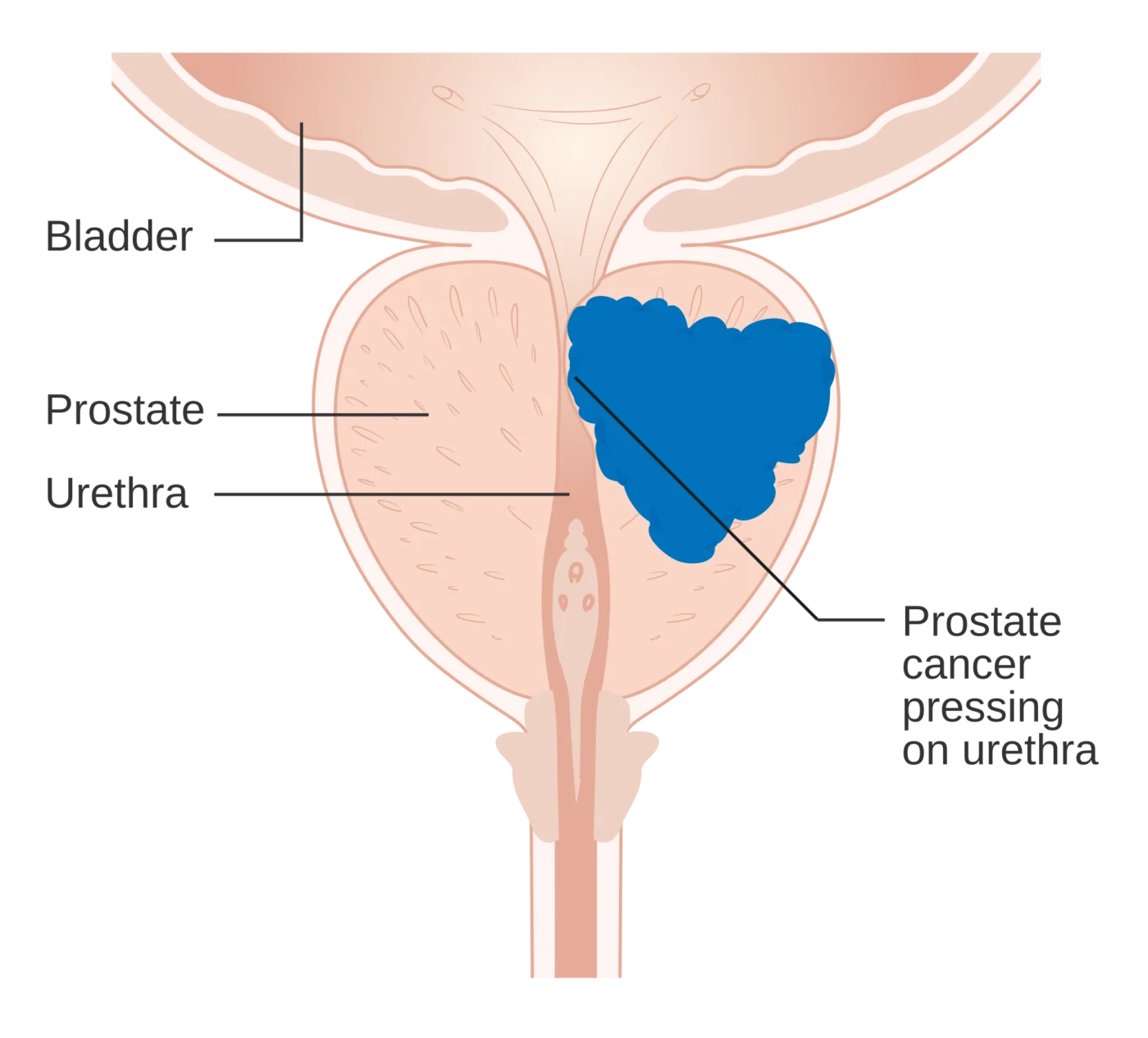 Tumore prostatico che comprime l'uretra