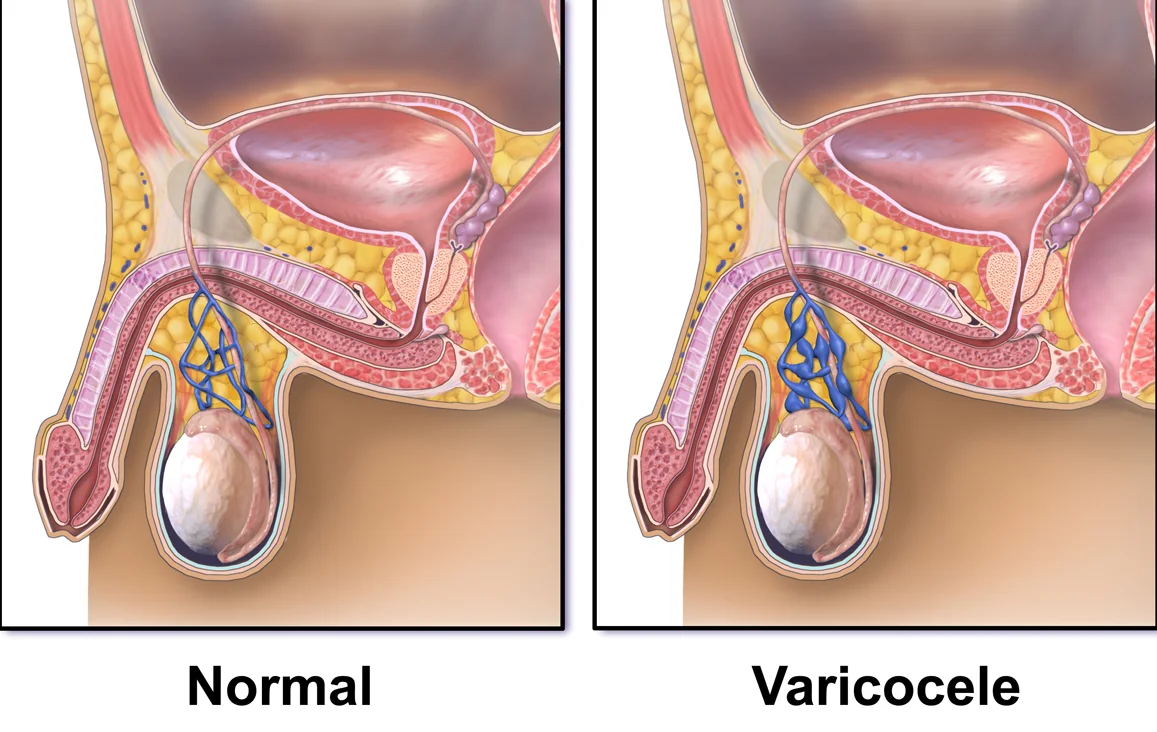 Schema del varicocele